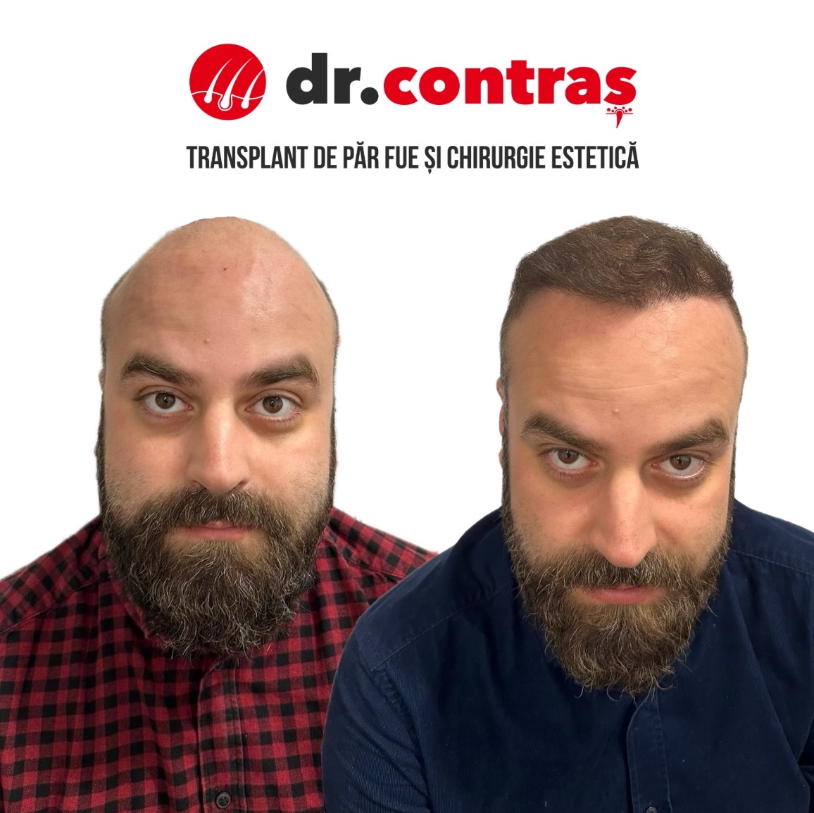 Transplant capilar FUE — caz