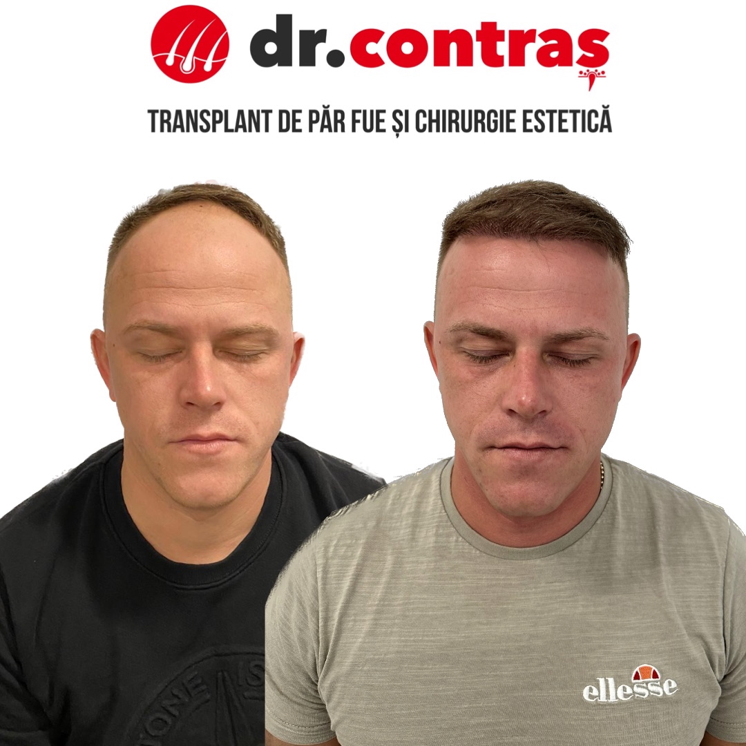 Tratament acid hialuronic