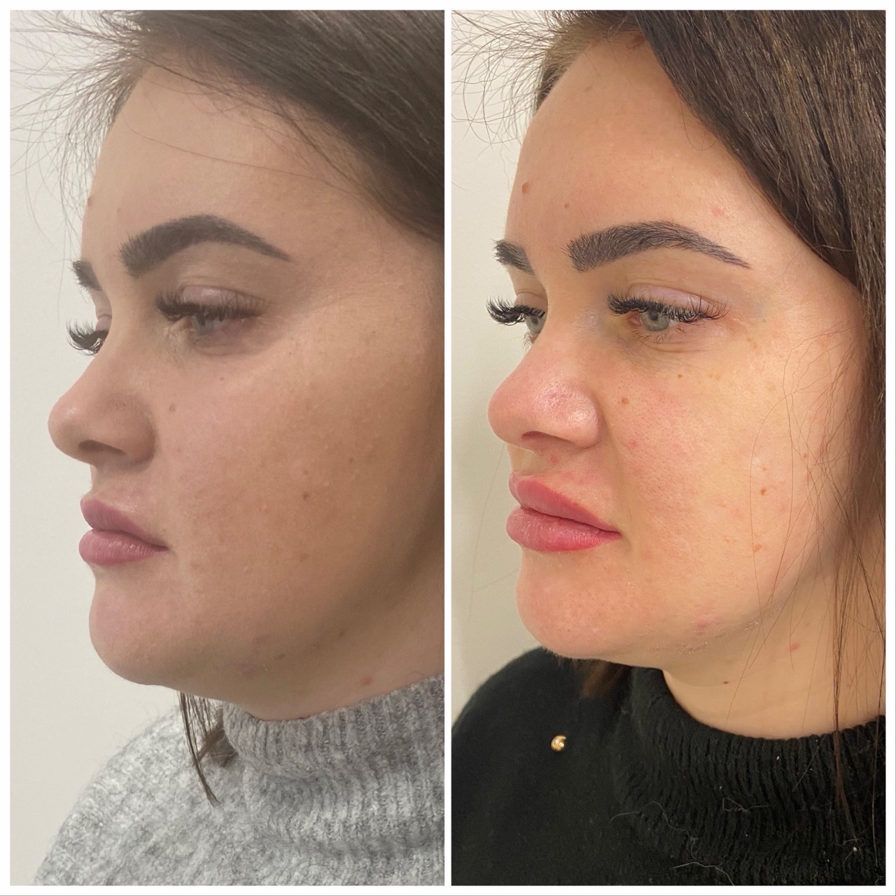 Acid hialuronic — contur facial, înainte și după