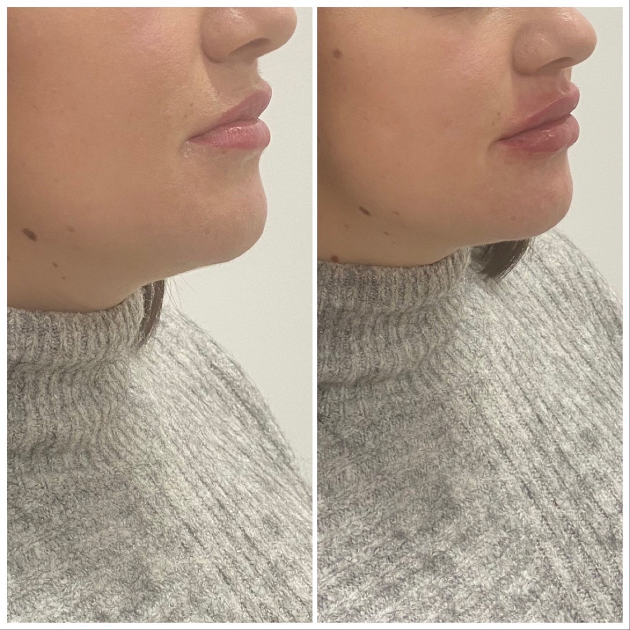 Acid hialuronic contur facial — înainte și după