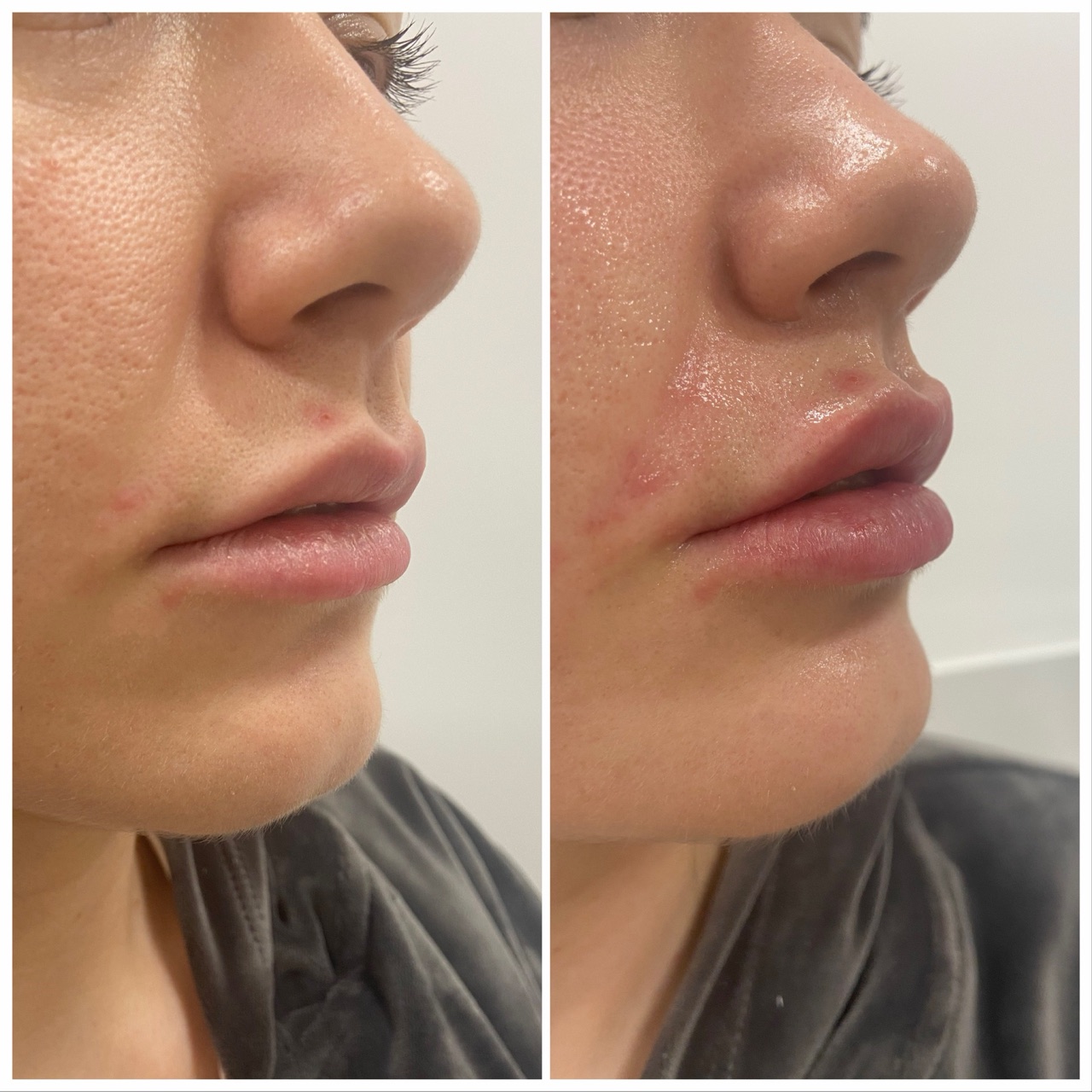 Acid hialuronic buze — înainte și după